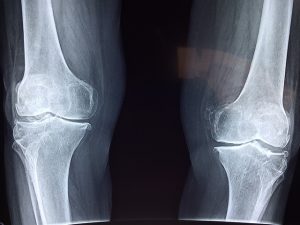 Read more about the article איך מונעים כאבי מפרקים נוספים לאחר ניתוח החלפת מפרק?